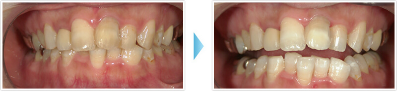 ホワイトニング