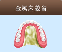 金属床義歯