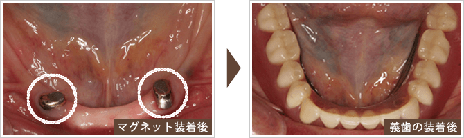 マグネットオーバーデンチャー症例
