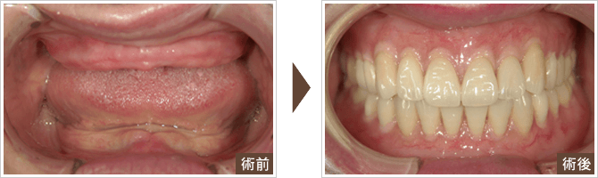 金属床症例