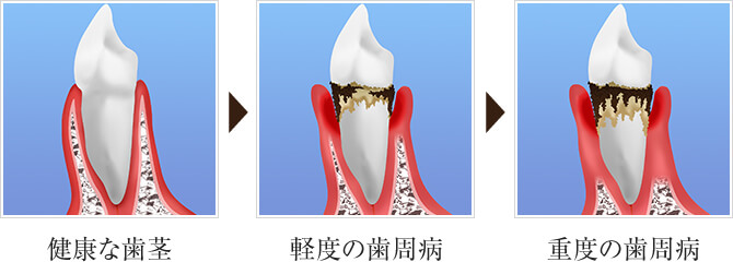 進行について