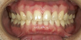 健康な歯茎の特徴