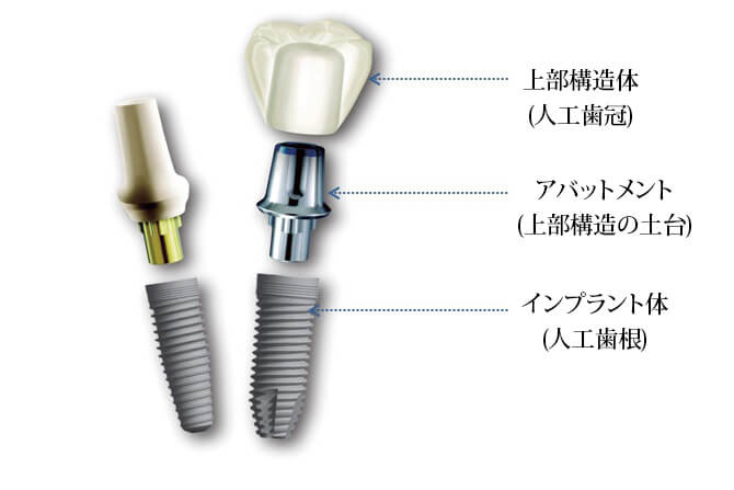 インプラントの構造