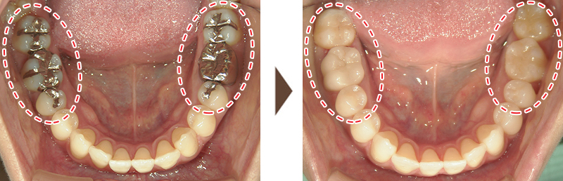 両下奥歯の治療